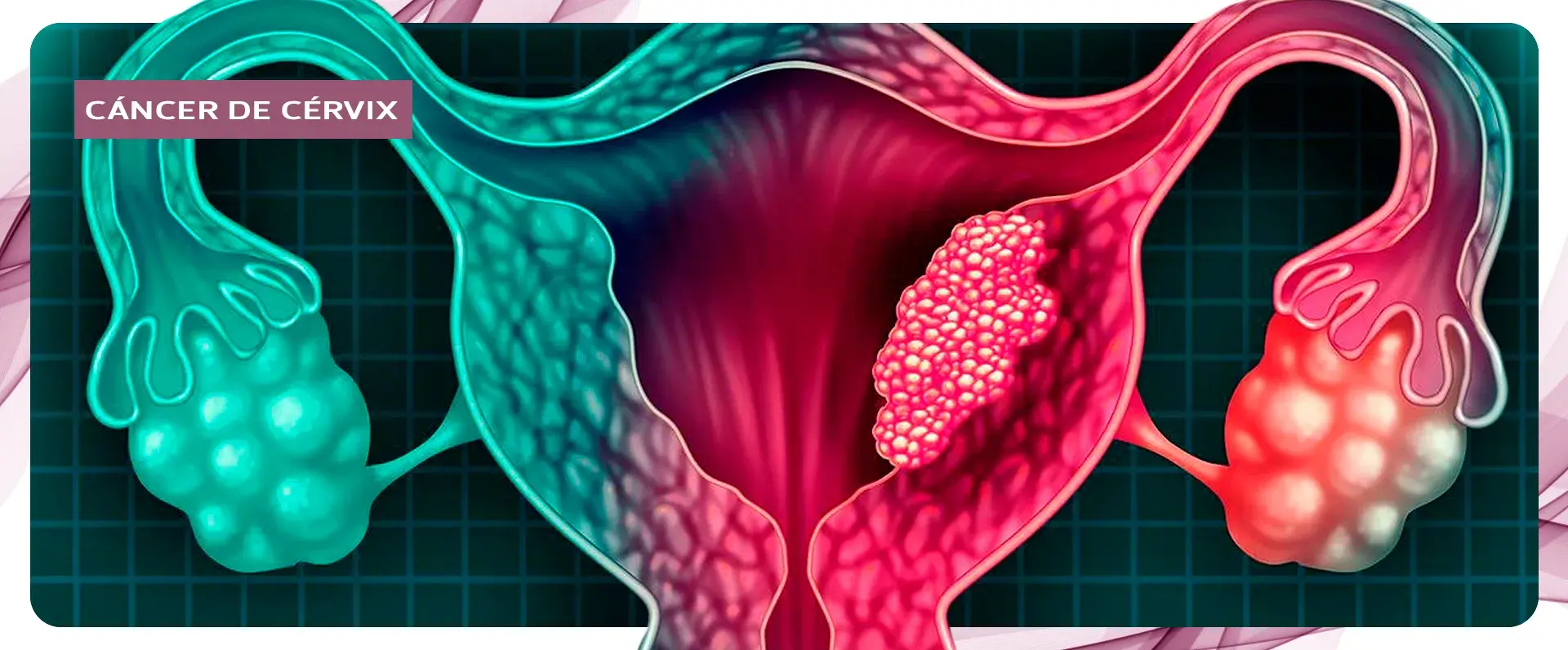 Tumor que se localiza en la parte superior del cérvix