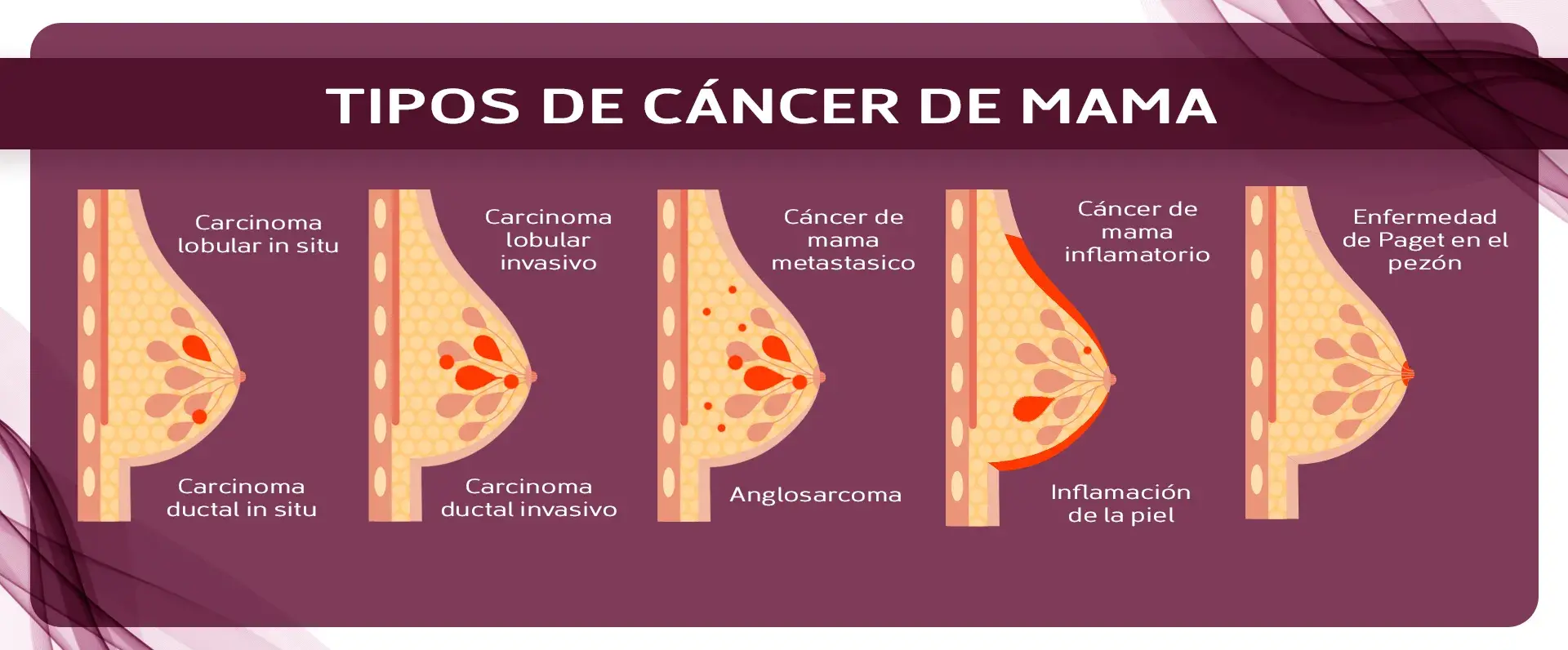 Tipos de cáncer de mama (cáncer lobular, cáncer ductal in situ, cáncer lobular y ductal invasivo, angiosarcoma, cáncer de mama inflamatorio, cáncer de mama triple negativo, enfermedad de Paget)