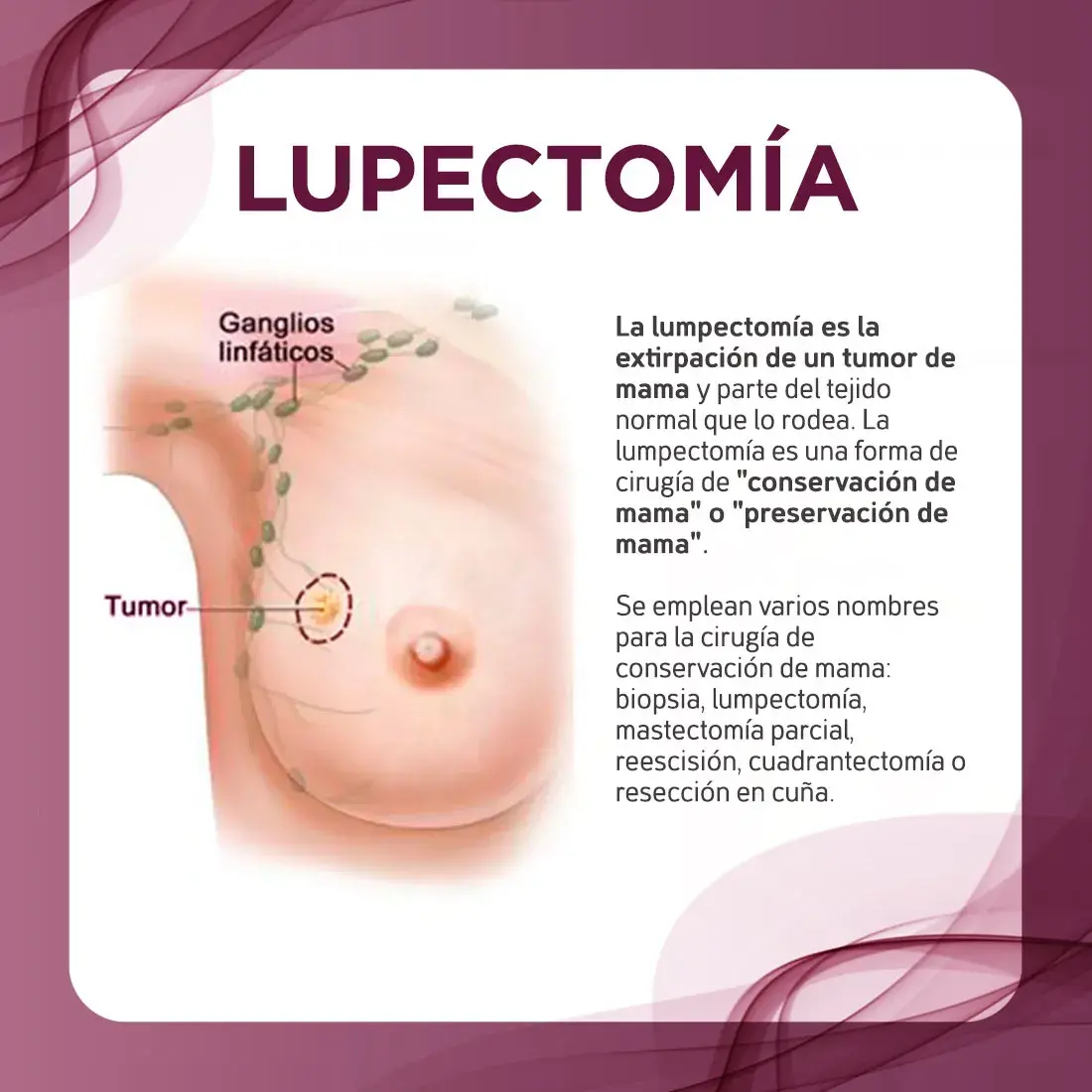 La cirugía conocida como mastectomía radical no conserva nada de la mama