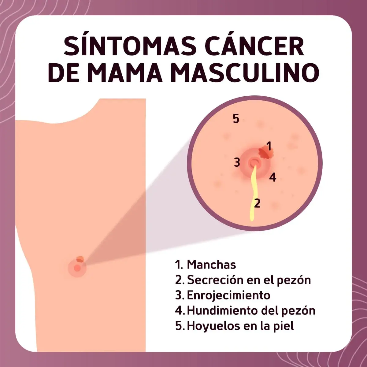 síntomas de cancer de mama en hombres