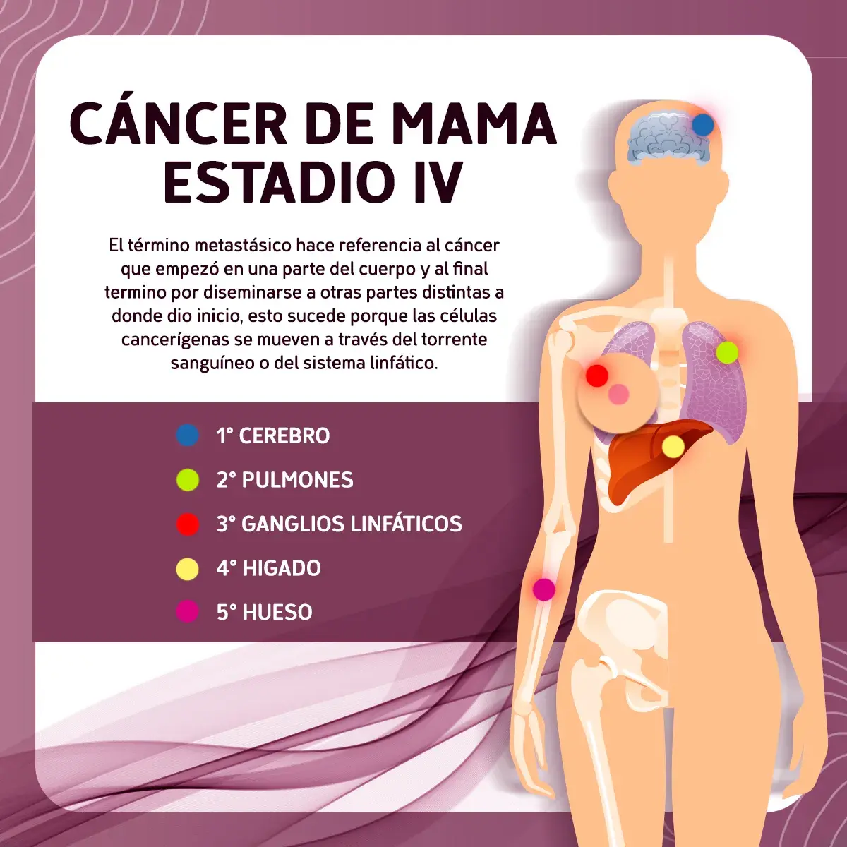Partes del cuerpo más comunes que sufren de metástasis por el cáncer de mama avanzado (cerebro, pulmones, ganglios linfáticos, hígado, hueso)