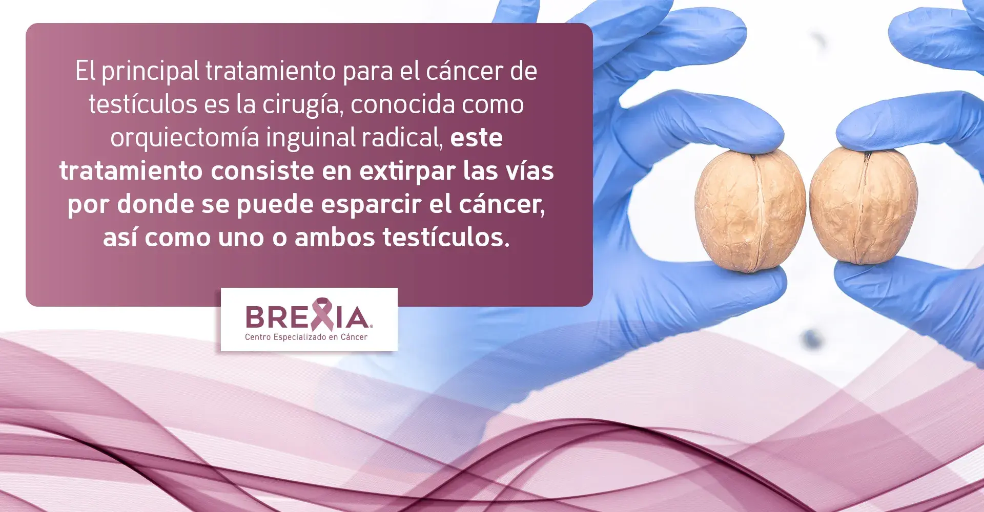 El tratamiento principal para el cáncer de testículo es la cirugía conocida como orquiectomía