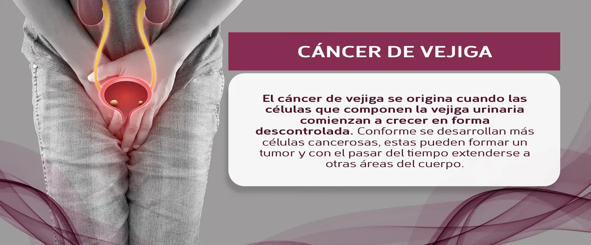 Crecimiento de células malignas que provocan cáncer de vejiga.