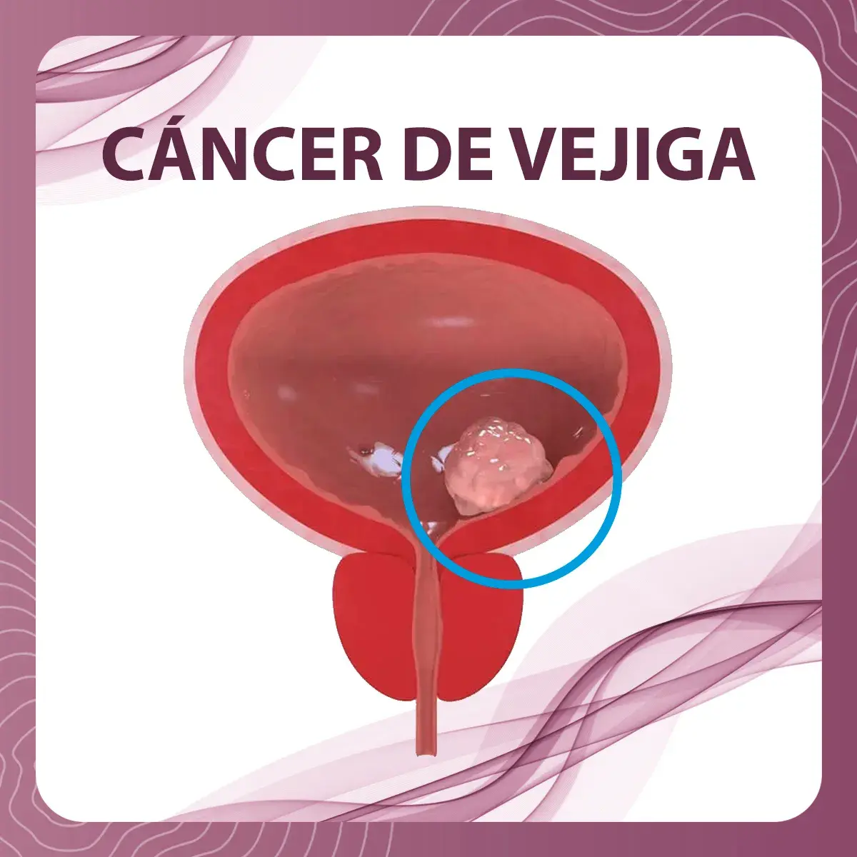 cáncer en el lado derecho de la vejiga.